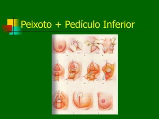 Peixoto + Pedículo Inferior
 