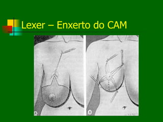 Lexer – Enxerto do CAM
 