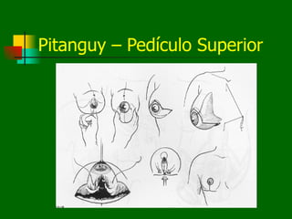 Pitanguy – Pedículo Superior
 