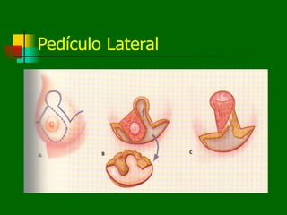 Pedículo Lateral
 