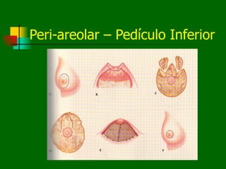 Peri-areolar – Pedículo Inferior
 
