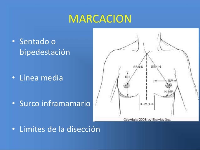 MAMOPLASTIA DE AUMENTO. IMPLANTES MAMARIOS MAMOPLASTIA DE AUMENTO. IMPLANTES MAMARIOS