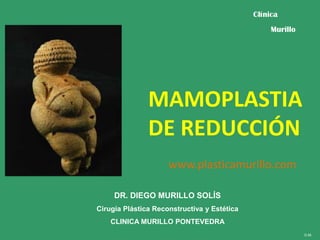 Clínica
Murillo

MAMOPLASTIA
DE REDUCCIÓN
www.plasticamurillo.com
DR. DIEGO MURILLO SOLÍS
Cirugía Plástica Reconstructiva y Estética
CLINICA MURILLO PONTEVEDRA
D.M.

 