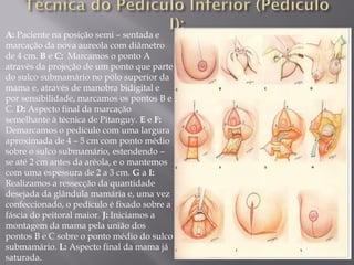A: Paciente na posição semi – sentada e
marcação da nova aureola com diâmetro
de 4 cm. B e C: Marcamos o ponto A
através da projeção de um ponto que parte
do sulco submamário no pólo superior da
mama e, através de manobra bidigital e
por sensibilidade, marcamos os pontos B e
C. D: Aspecto final da marcação
semelhante à técnica de Pitanguy. E e F:
Demarcamos o pedículo com uma largura
aproximada de 4 – 5 cm com ponto médio
sobre o sulco submamário, estendendo –
se até 2 cm antes da aréola, e o mantemos
com uma espessura de 2 a 3 cm. G a I:
Realizamos a ressecção da quantidade
desejada da glândula mamária e, uma vez
confeccionado, o pedículo é fixado sobre a
fáscia do peitoral maior. J: Iniciamos a
montagem da mama pela união dos
pontos B e C sobre o ponto médio do sulco
submamário. L: Aspecto final da mama já
saturada.
 