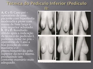 A, C e E: Caso pré –
operatório de uma
paciente com hipertrofia
moderada e ptose com
mama de base larga e
pólo superior achatado.
B, D e F: Resultado
obtido após a indicação
da técnica do pedículo I.
podemos notar no pós –
operatório de 1 ano a
boa posição do cone
mamário e o
preenchimento do pólo
superior da nova mama,
produzindo um
contorno mamário mais
adequado.
 