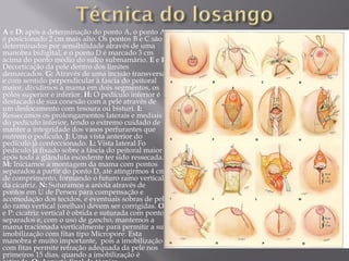 A e D: após a determinação do ponto A, o ponto A
é posicionado 2 cm mais alto. Os pontos B e C são
determinados por sensibilidade através de uma
manobra bidigital, e o ponto D é marcado 3 cm
acima do ponto médio do sulco submamário. E e F:
Decorticação da pele dentro dos limites
demarcados. G: Através de uma incisão transversal
e com sentido perpendicular à fascia do peitoral
maior, dividimos a mama em dois segmentos, os
pólos superior e inferior. H: O pedículo inferior é
destacado de sua conexão com a pele através de
um deslocamento com tesoura ou bisturi. I:
Ressecamos os prolongamentos laterais e mediais
do pedículo inferior, tendo o extremo cuidado de
manter a integridade dos vasos perfurantes que
nutrem o pedículo. J: Uma vista anterior do
pedículo já confeccionado. L: Vista lateral Fo
pedículo já fixado sobre a fáscia do peitoral maior
após toda a glândula excedente ter sido ressecada.
M: Iniciamos a montagem da mama com pontos
separados a partir do ponto D, até atingirmos 4 cm
de comprimento, formando o futuro ramo vertical
da cicatriz. N: Suturamos a aréola através de
pontos em U de Perseu para compensação e
acomodação dos tecidos, e eventuais sobras de pele
do ramo vertical (orelhas) devem ser corrigidas. O
e P: cicatriz vertical é obtida e suturada com pontos
separados e, com o uso de gancho, mantemos a
mama tracionada verticalmente para permitir a sua
imobilização com fitas tipo Micropore. Esta
manobra é muito importante, pois a imobilização
com fitas permite retração adequada da pele nos
primeiros 15 dias, quando a imobilização é
 