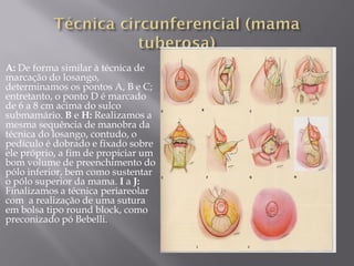 A: De forma similar à técnica de
marcação do losango,
determinamos os pontos A, B e C;
entretanto, o ponto D é marcado
de 6 a 8 cm acima do sulco
submamário. B e H: Realizamos a
mesma sequência de manobra da
técnica do losango, contudo, o
pedículo é dobrado e fixado sobre
ele próprio, a fim de propiciar um
bom volume de preenchimento do
pólo inferior, bem como sustentar
o pólo superior da mama. I a J:
Finalizamos a técnica periareolar
com a realização de uma sutura
em bolsa tipo round block, como
preconizado pó Bebelli.
 