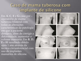 Em A, C, E e G: caso pré –
operatório de mama
tuberosa bilateral com
todas as alterações
características da patologia
em que a paciente
desejava, além de corrigir a
deformidade, aumentar o
volume mamário. Em B, D,
F e H: resultado obtido
após 1 ano através da
técnica circunferencial com
uso de implantes
mamários de silicone.
 