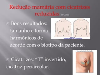 Redução mamária com cicatrizes
reduzidas (537 até 545)
 Bons resultados:
tamanho e forma
harmônicos de
acordo com o biotipo da paciente.
 Cicatrizes: “T” invertido,
cicatriz periareolar.
 