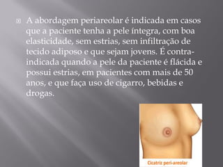  A abordagem periareolar é indicada em casos
que a paciente tenha a pele íntegra, com boa
elasticidade, sem estrias, sem infiltração de
tecido adiposo e que sejam jovens. É contra-
indicada quando a pele da paciente é flácida e
possui estrias, em pacientes com mais de 50
anos, e que faça uso de cigarro, bebidas e
drogas.
 