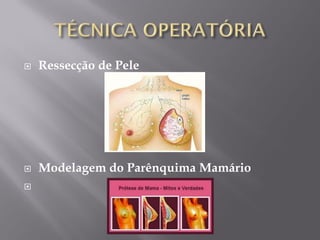  Ressecção de Pele
 Modelagem do Parênquima Mamário

 