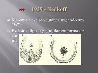  Marcava a excisão cutânea traçando um
“W”.
 Excisão adiposo-glandular em forma de
cunha na base distal, transposição de
mamilo e aréola.
 
