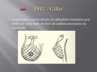  Suspensão e sustentação da glândula mamária por
meio de uma rede de fios de náilon ancorada na
clavícula.
 