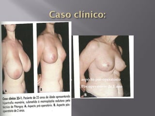 A) aspécto pré-operatório
B) Pós operatório de 1 ano
 