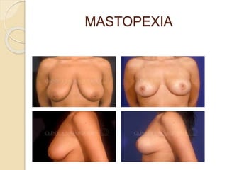 MASTOPEXIA 
 