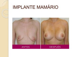 IMPLANTE MAMÁRIO 
 