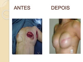 ANTES DEPOIS 
 