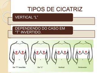 TIPOS DE CICATRIZ 
VERTICAL “L” 
DEPENDENDO DO CASO EM 
“T” INVERTIDO. 
 