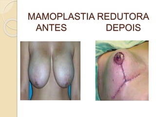 MAMOPLASTIA REDUTORA 
ANTES DEPOIS 
 