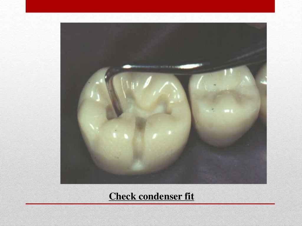 procedure for amalgam restoration