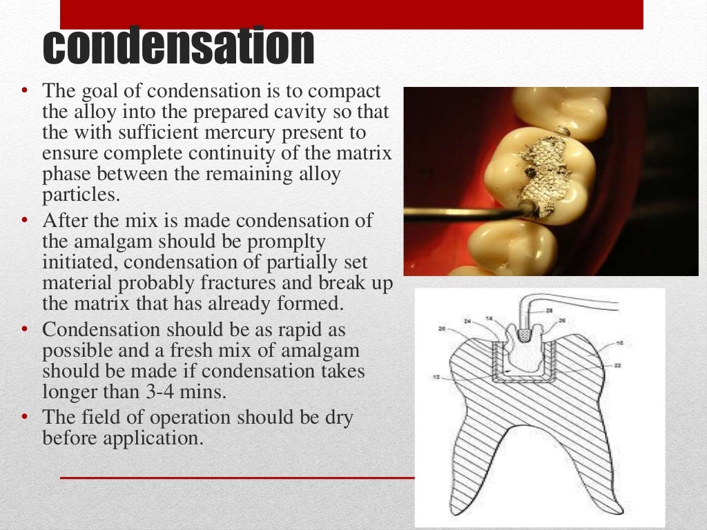 procedure for amalgam restoration
