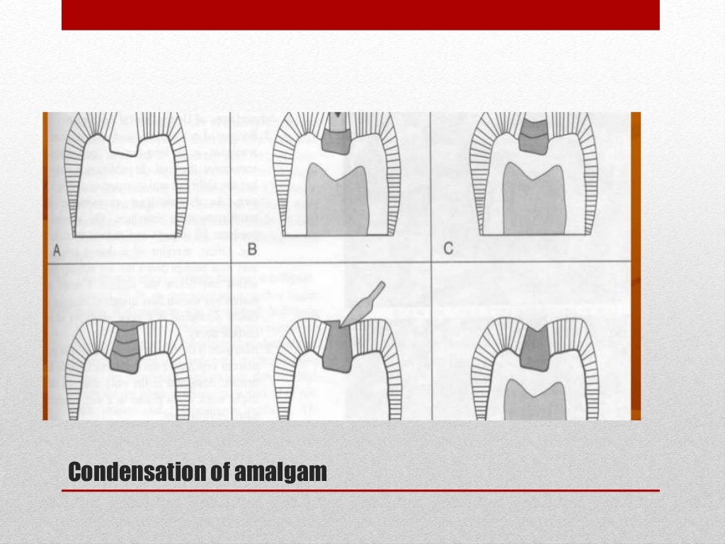 procedure for amalgam restoration