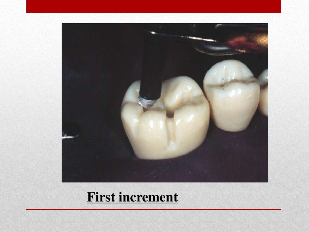 procedure for amalgam restoration