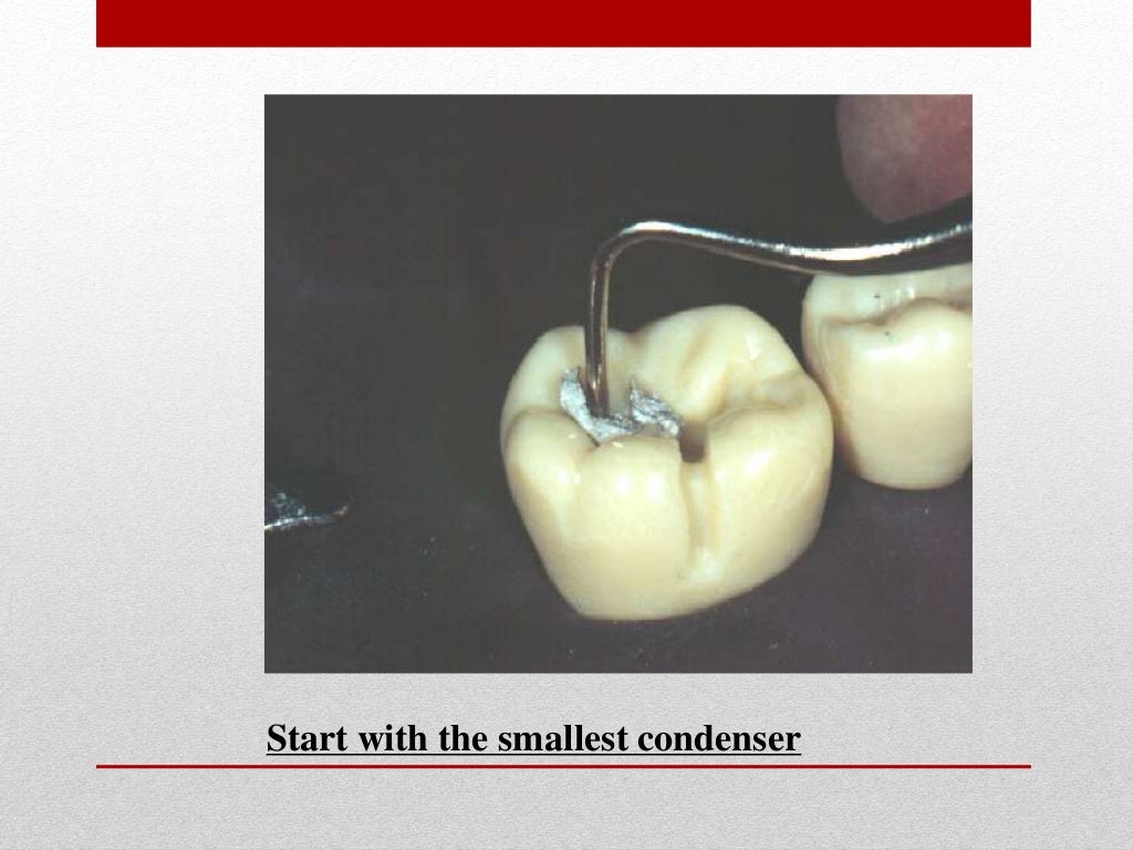 procedure for amalgam restoration