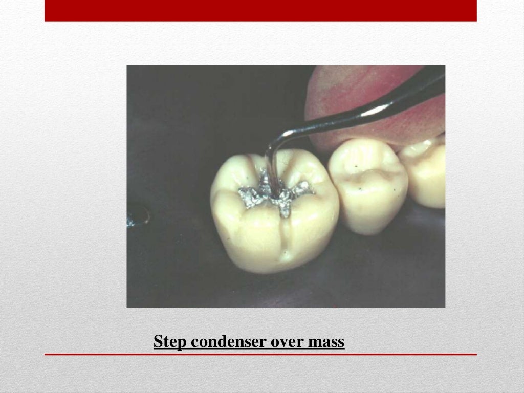 procedure for amalgam restoration