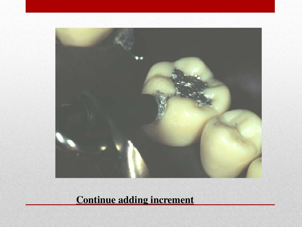 procedure for amalgam restoration