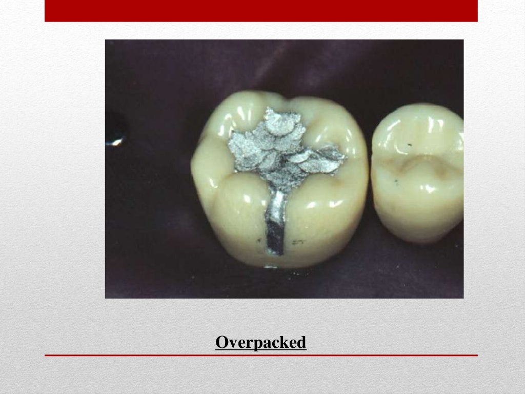 procedure for amalgam restoration