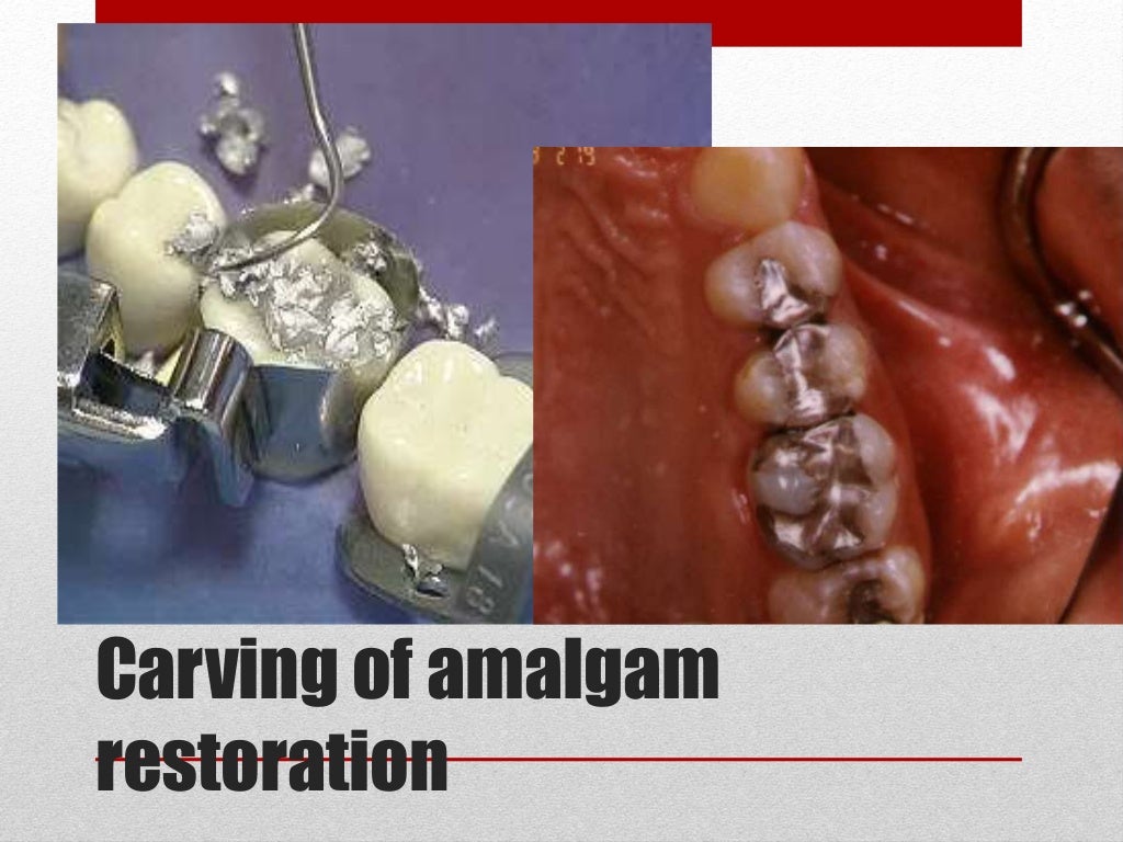 procedure for amalgam restoration