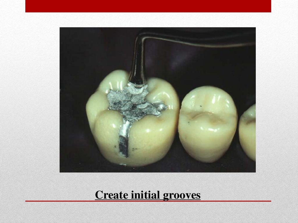 procedure for amalgam restoration