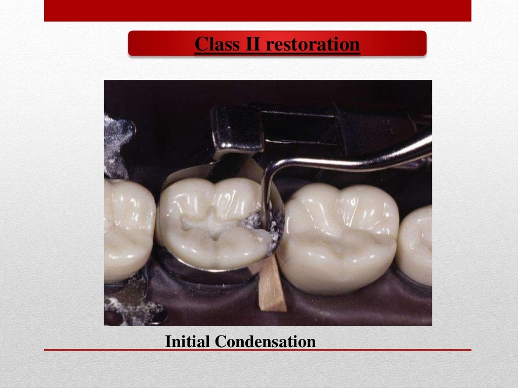 procedure for amalgam restoration