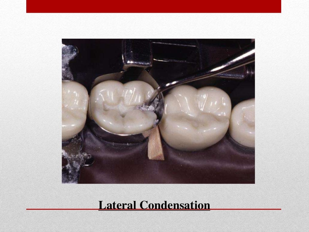 procedure for amalgam restoration