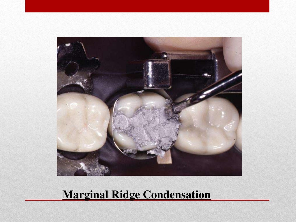 procedure for amalgam restoration
