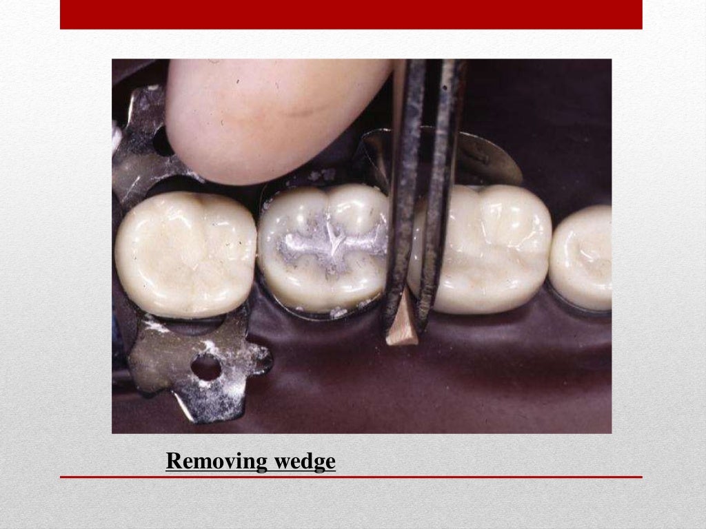 procedure for amalgam restoration