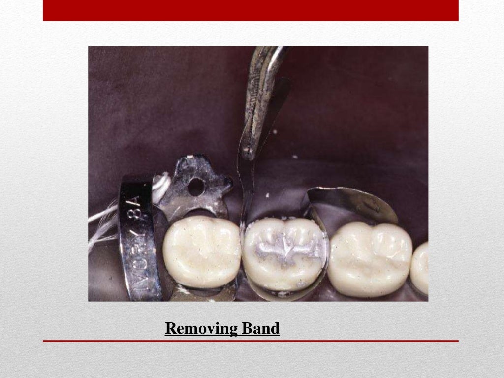 procedure for amalgam restoration