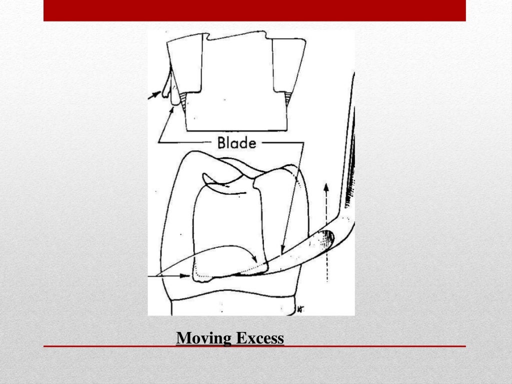 procedure for amalgam restoration