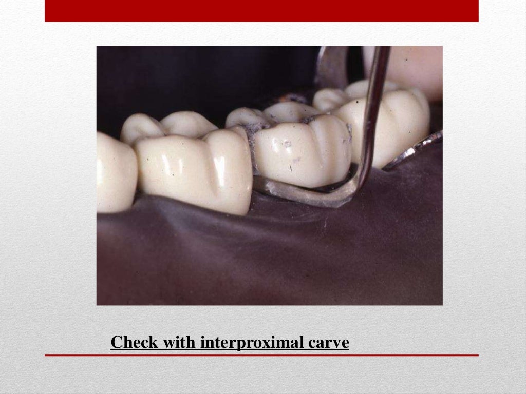 procedure for amalgam restoration