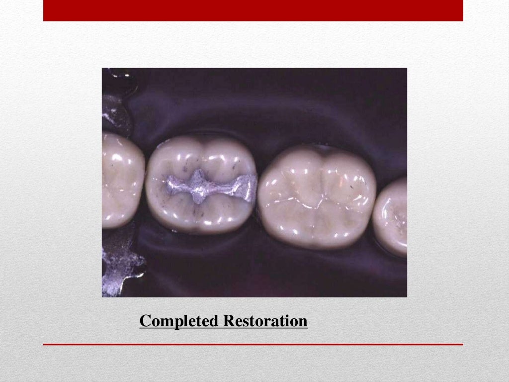 procedure for amalgam restoration