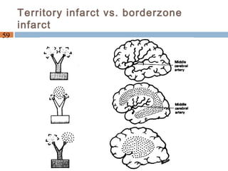 Border Zone Infarct Pattern Manage ischemic stroke pts | PPT