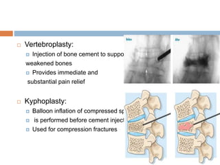  Vertebroplasty:
 Injection of bone cement to support
weakened bones
 Provides immediate and
substantial pain relief
 Kyphoplasty:
 Balloon inflation of compressed spine bone
 is performed before cement injection
 Used for compression fractures
 