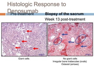 Histologic Response to
Denosumab Pre-treatment Biopsy of the sacrum
Week 13 post-treatment
Giant cells No giant cells
Irregular bone trabeculae (ovals)
Osteoid (arrows)
 