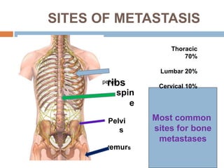 SITES OF METASTASIS
ribs
spin
e
pelvis
Pelvi
s
femurs
Most common
sites for bone
metastases
Thoracic
70%
Lumbar 20%
Cervical 10%
 