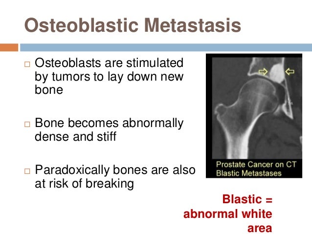 Managemaent of bone secondaries
