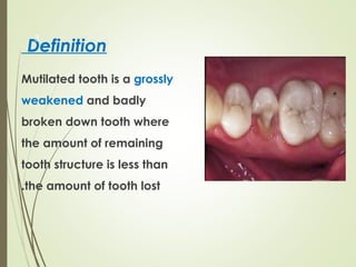 Managemant of Mutilated Vital Teeth presentation | PPT