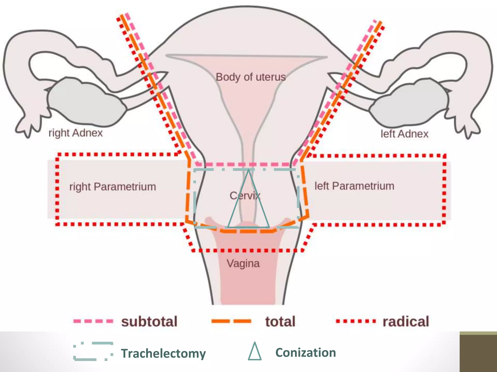 Trachelectomy Conization
 