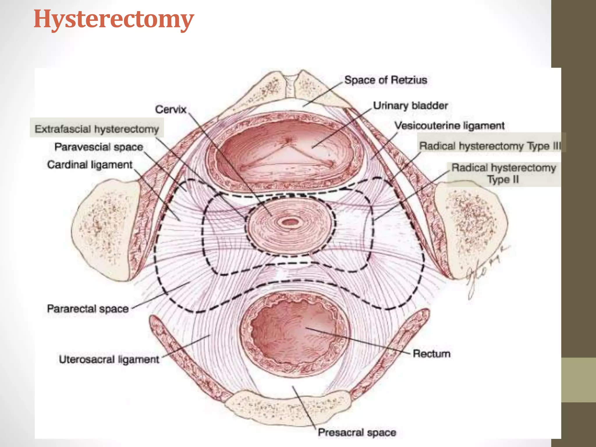 Hysterectomy
 