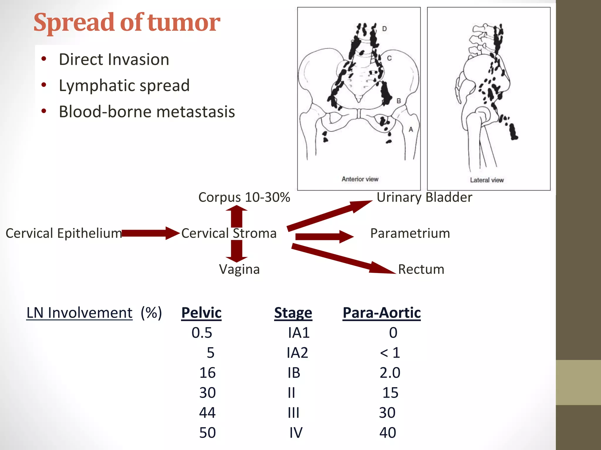 • Direct Invasion
• Lymphatic spread
• Blood-borne metastasis
Corpus 10-30% Urinary Bladder
Cervical Epithelium Cervical Stroma Parametrium
Vagina Rectum
Spreadof tumor
LN Involvement (%) Pelvic Stage Para-Aortic
0.5 IA1 0
5 IA2 < 1
16 IB 2.0
30 II 15
44 III 30
50 IV 40
 